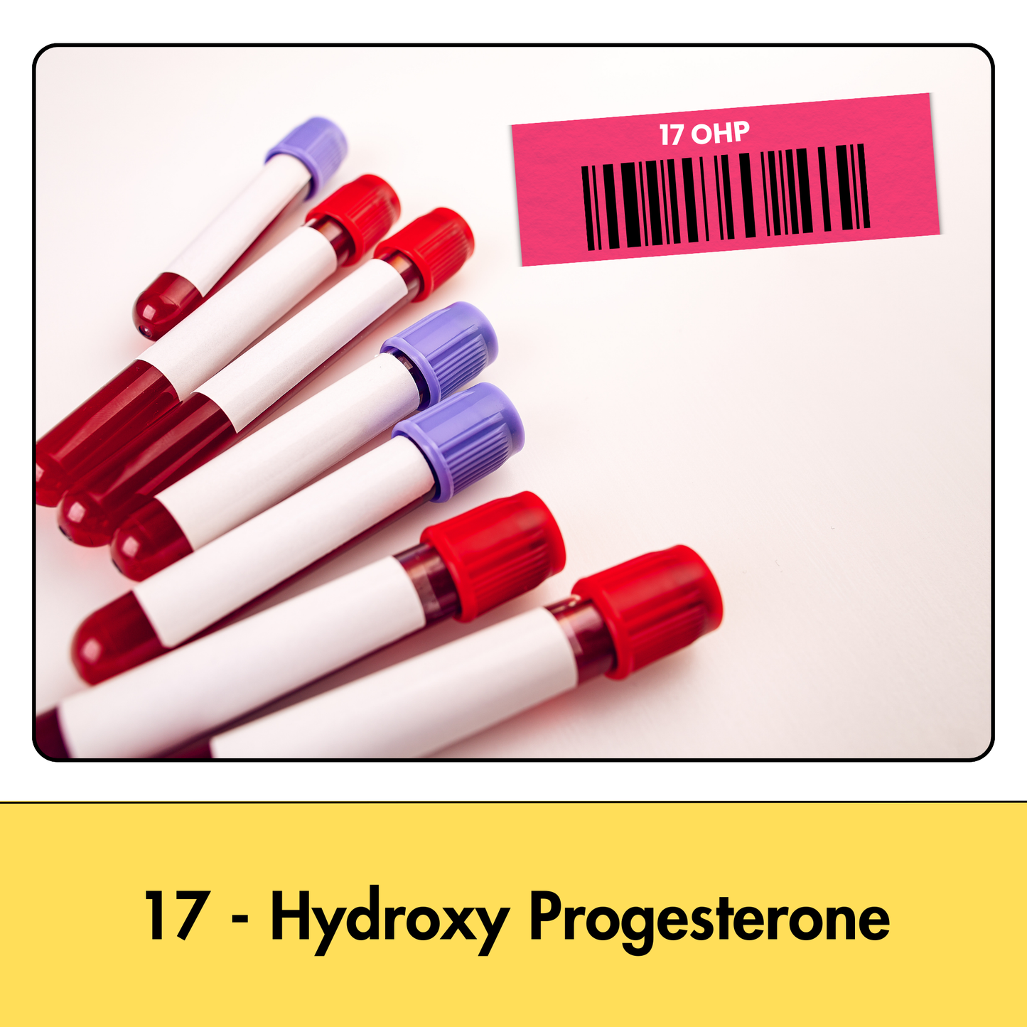 17 - Hydroxy Progesterone (17-OHP) test in Kolkata